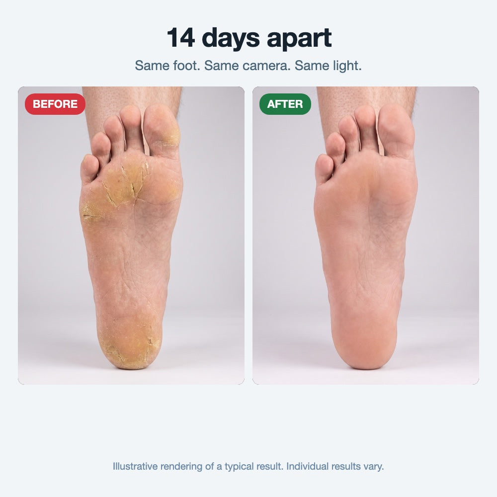 Illustrative before and after: cracked heel and smooth skin fourteen days later