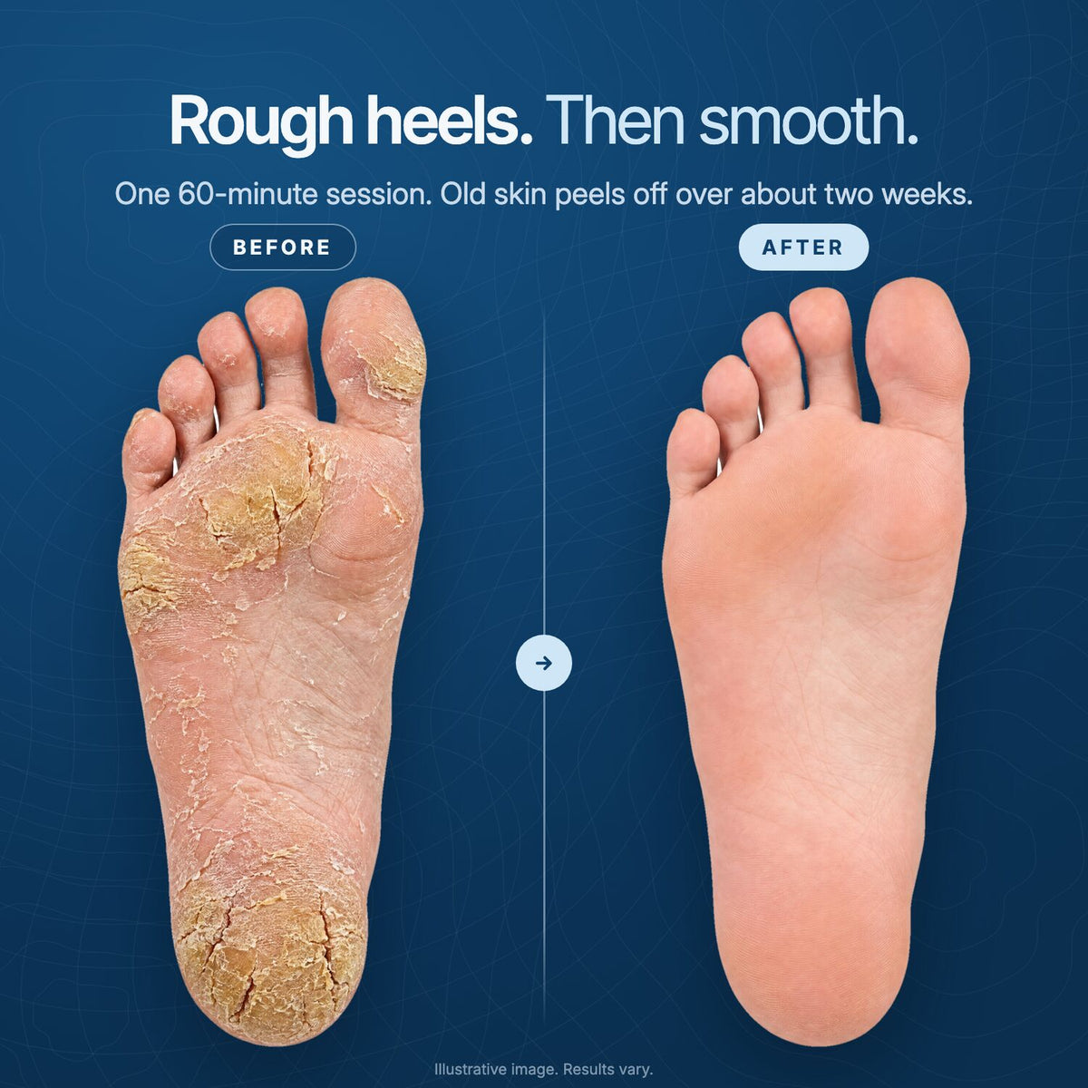 Rough, cracked heels before and smooth heels after, illustrative image