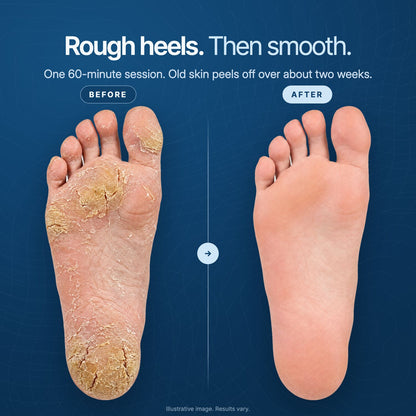 Rough, cracked heels before and smooth heels after, illustrative image